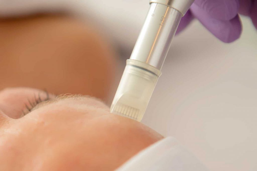 microneedling forever jong