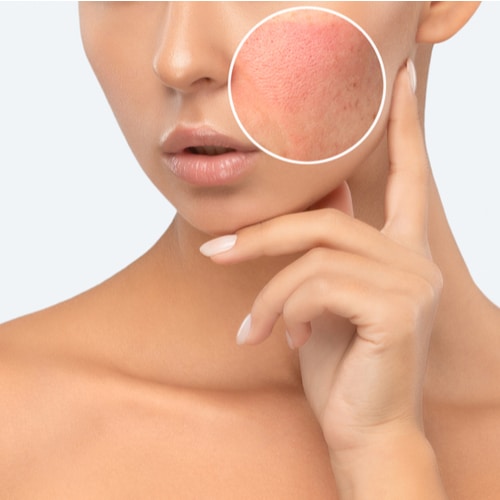 Vrouw met grove poriën