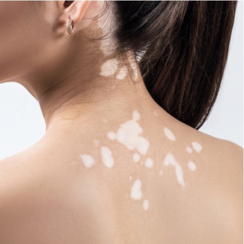 Een vrouw met Vitiligo op haar nek